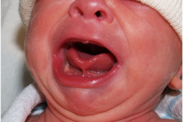 לשון קשורה – הגדרה, אבחנה וטיפול בלשון קשורה אצל תינוקות